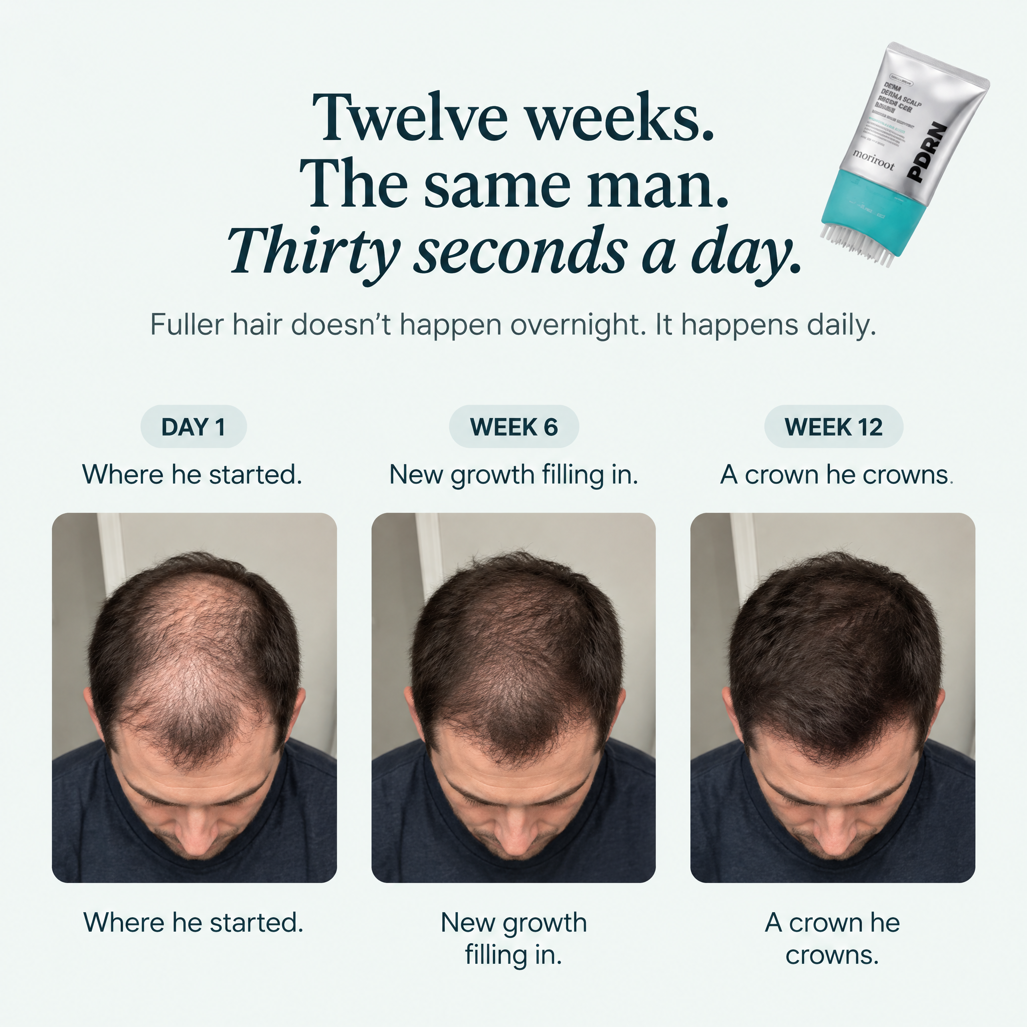 Korea's Viral Brush-On Scalp Serum (PDRN Onto Your Crown & Hairline in 30 Seconds, Not Into Your Hair)